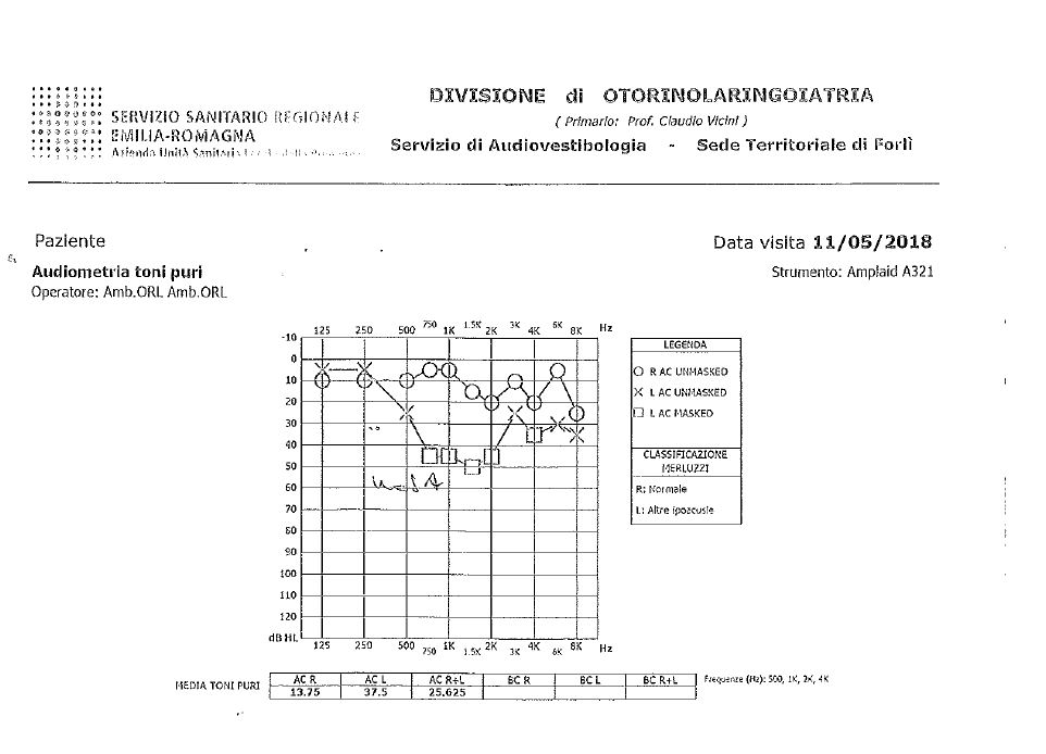 sordità improvvisa