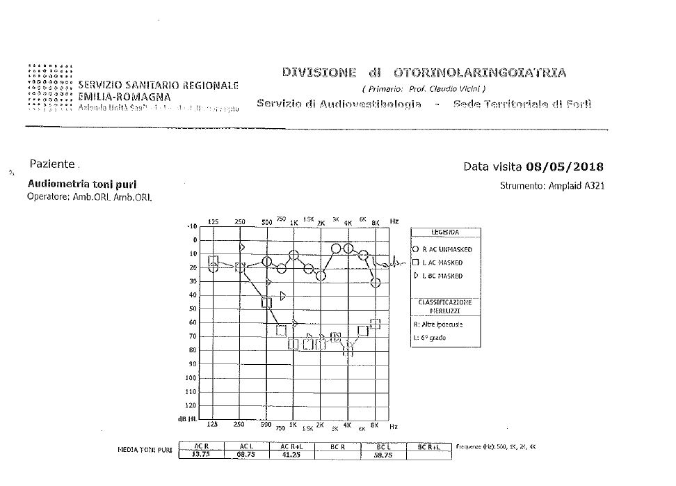 sordità improvvisa