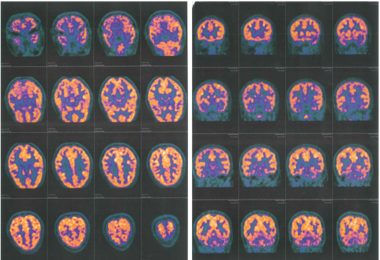 scomparsa lesioni corteccia cerebrale Martina Fumolo